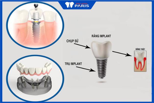 Giải đáp nhanh: Thời gian chế tạo răng Implant mất bao lâu?